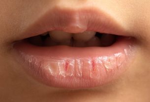 علت ترک خوردن لب چیست و چگونه درمان می‌شود؟