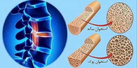 راهکارهای مؤثر برای جلوگیری از پوکی استخوان در تمام دورههای زندگی