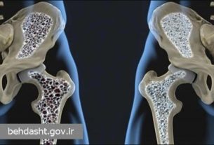 پیشگیری از پوکی استخوان با فیزیوتراپی و سبک زندگی سالم؛ راهکارهای اثباتشده برای سالمندان